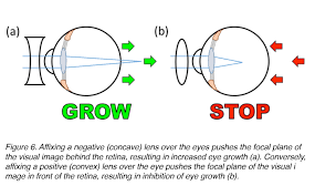 Understanding Lens-Induced Myopia