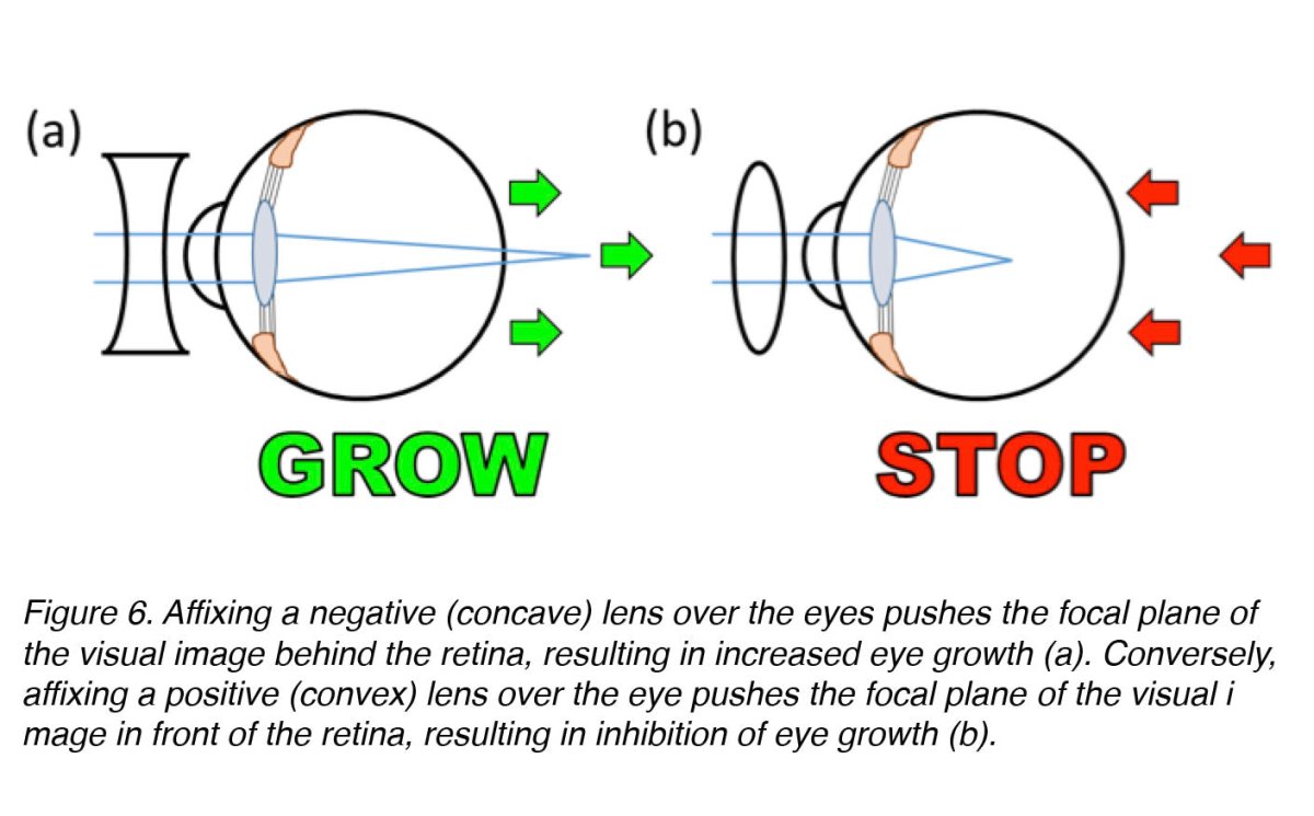 Essential Eye Care: Understanding Myopia and Its Treatment Options - PhiFinery