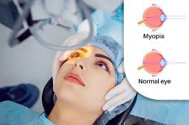 The Perils and Irreversibility of Eye Surgery for Myopia