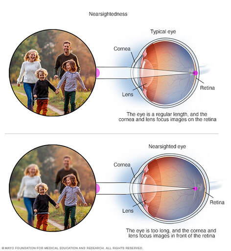 The Impact of Digital Screen Viewing in Dim Lighting on Myopia Development: A Review of Mechanisms and Implications - PhiFinery