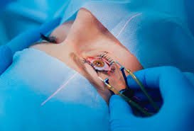 The Irreversible Gamble: Why Refractive Eye Surgery for Myopia Might Not Be Worth the Risk - PhiFinery